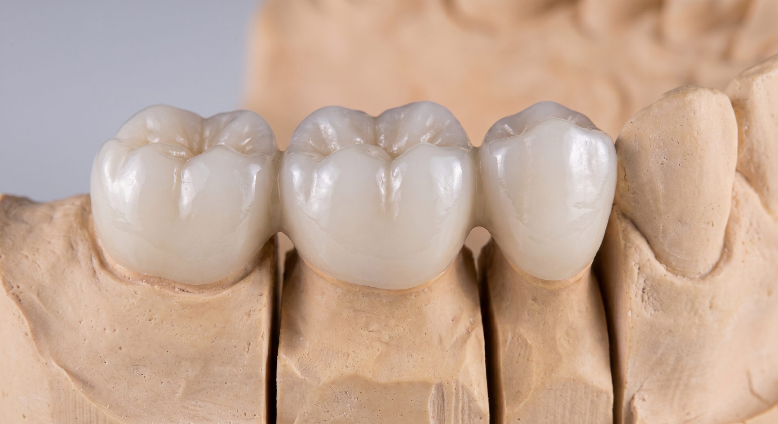 Three unit posterior dental bridge